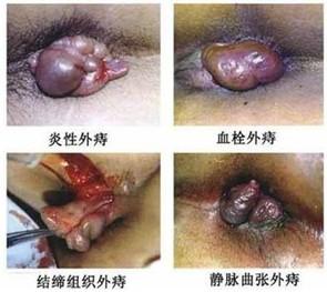 炎性外痔你做好预防了吗？