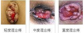 混合痔发展图