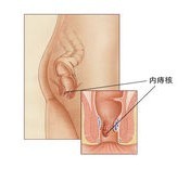 内痔痔核