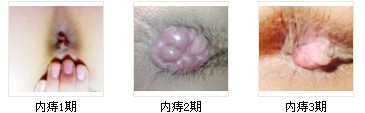 内痔发展图